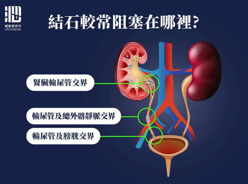 新式碎石手術減低併發症|包皮槍,台北泌尿科推薦,割包皮健保,恢復,包皮槍保險,費用