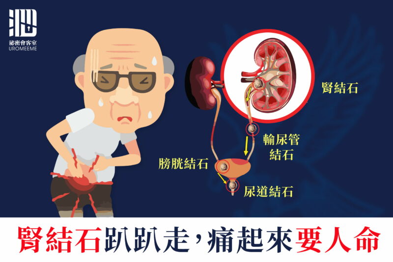 腎結石，痛起來要人命！你平常水喝夠了嗎？